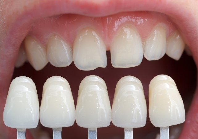 Smile compared with metal free dental restoration shade options