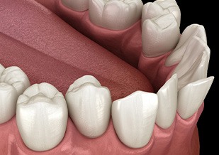 Illustration of crooked teeth