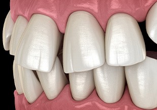 Illustration of gapped teeth