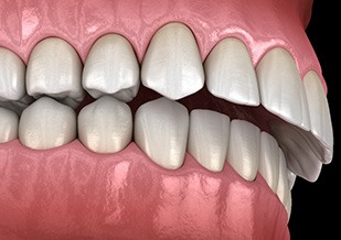 Illustration of an overbite