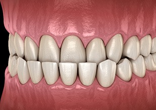 Illustration of an underbite