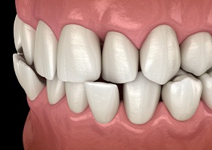 Illustration of a crossbite