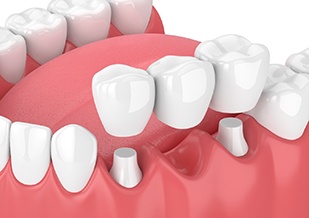 an illustration of a traditional dental bridge in Virginia Beach