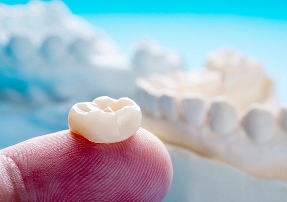 Closeup of dental crowns in Virginia Beach 