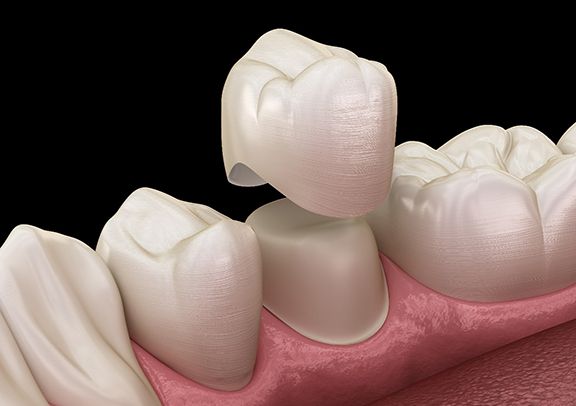3D illustration Dental crowns in Virginia Beach