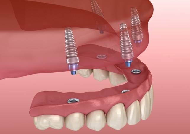 Closeup of full dentures next to dental tools