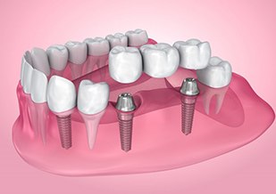 Illustration of dental implants with bridge