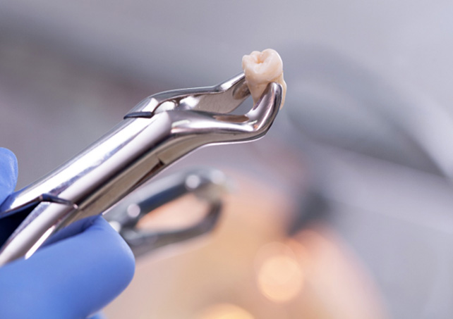 Dentist holding tooth in forceps after extraction in Virginia Beach, VA