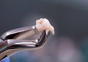 Close-up of tooth in forceps after tooth extraction in Virginia Beach, VA