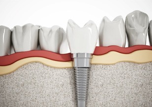 Illustration of a single dental implant in Virginia Beach, VA