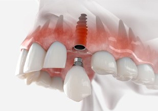 Illustration of crown being attached to dental implant in Virginia Beach, VA
