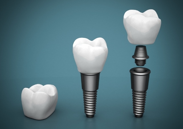 Animated components of a dental implant supported dental crown