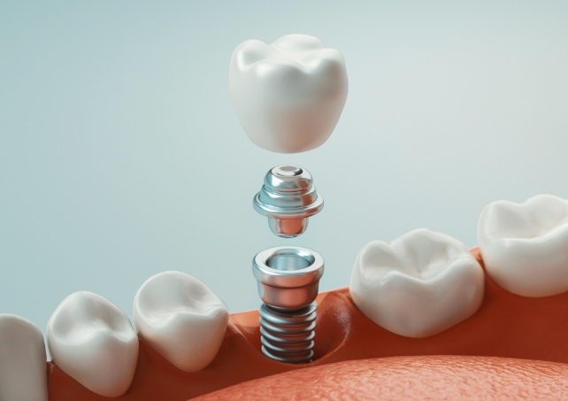 Aniamted smile representing the four step dental implant process