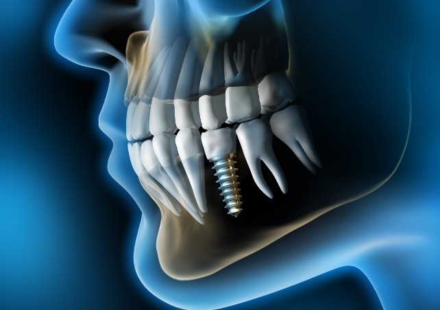 Animated smile with dental implant supported replacement tooth