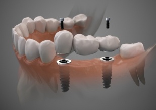 Animated smile during dental implant supported fixed bridge placement