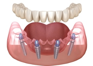 Animated smile during dental implant supported denture placement