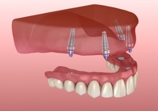 Animated smile during all on four dental implant denture placement