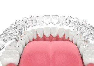Illustration of clear aligner being placed on bottom row of teeth
