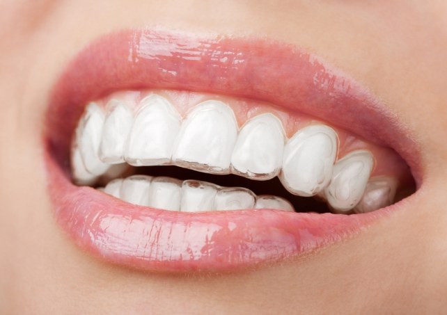 A close-up view of Invisalign aligners