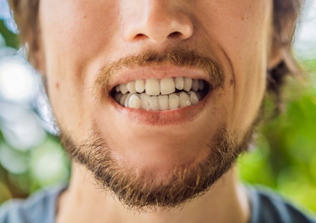 Patient's smile with Invisalign tray in place