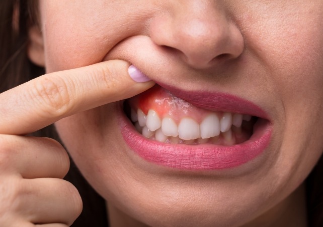 Person with damaged gum tissue which is a sign of oral cancer checked for during screenings