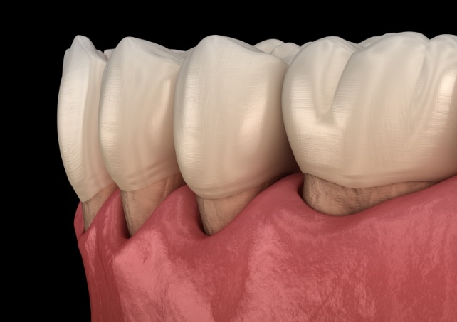 Animated smile in need of periodontal therapy for gum disease