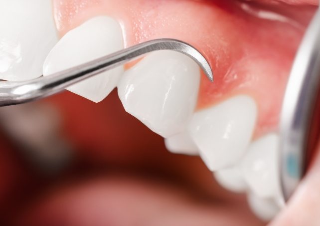 Animated smile during scaling and root planing treatment