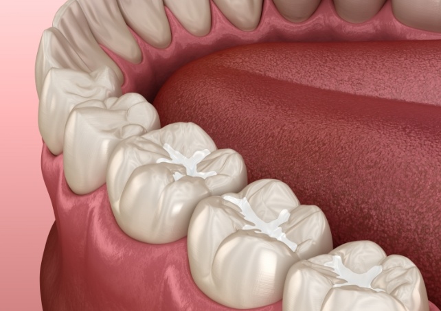 Animated smile with tooth colored fillings