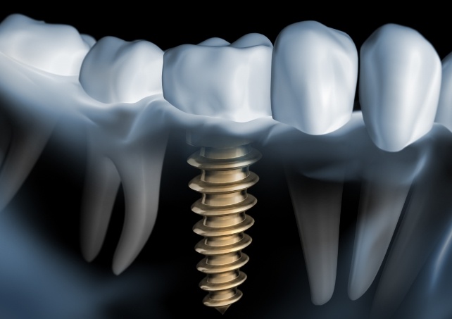 Animated dental implant supported replacement tooth