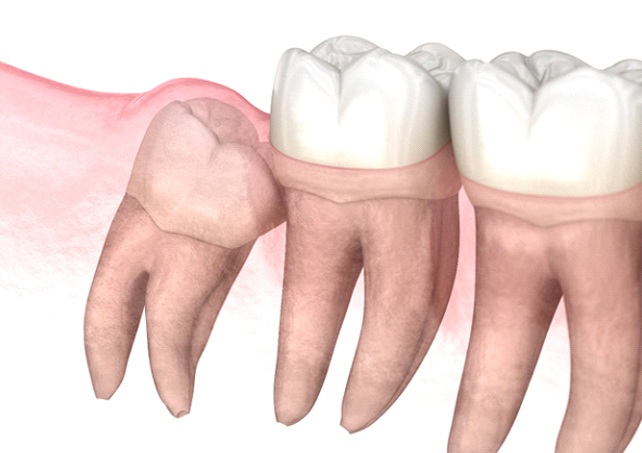 impacted wisdom teeth illustration teeth extractions in Virginia Beach