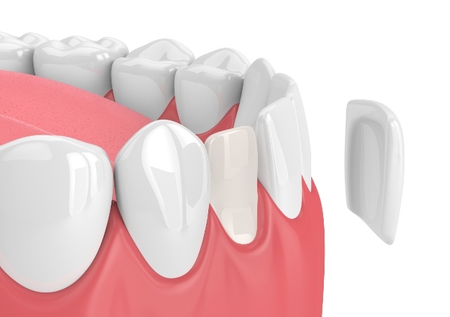 Animated smile during porcelain veneer placement