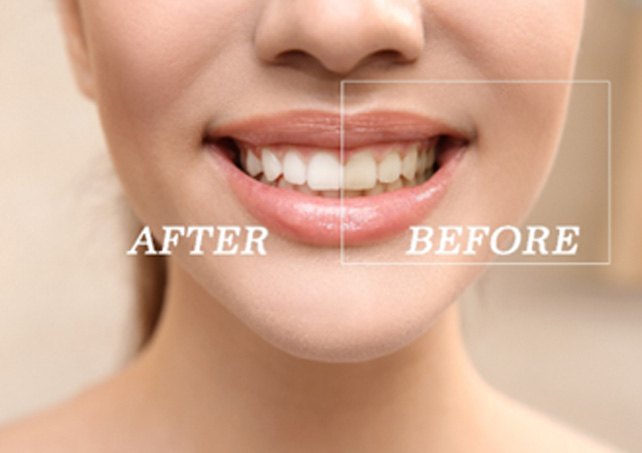 Closeup of woman's smile before and after teeth whitening treatment
