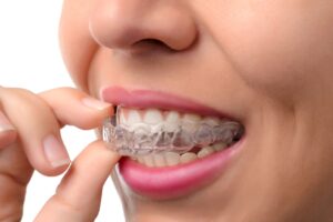 Nose to chin view of woman inserting Invisalign